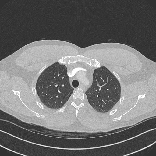 Bilateral atelectasis (Radiopaedia 48666-53675 Axial lung window 26).jpg