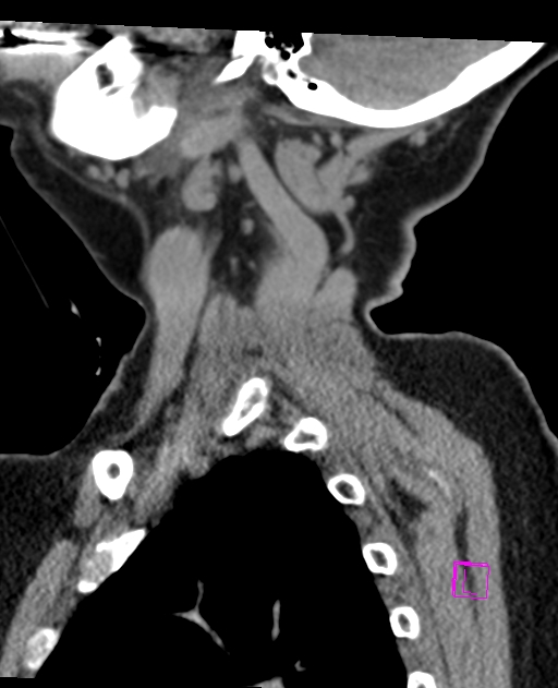 Bilateral atlanto-occipital assimilation (Radiopaedia 28350-28603 D 13).jpg