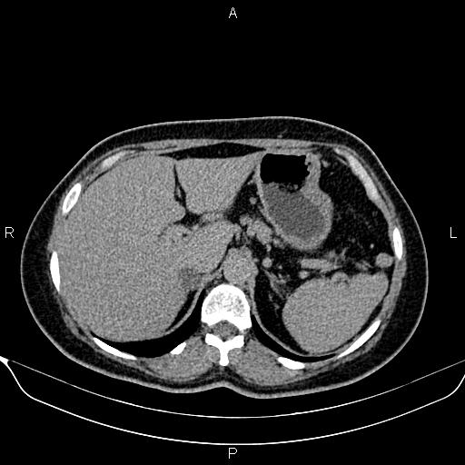 File:Bilateral benign adrenal adenomas (Radiopaedia 86912-103124 Axial C+ delayed 23).jpg