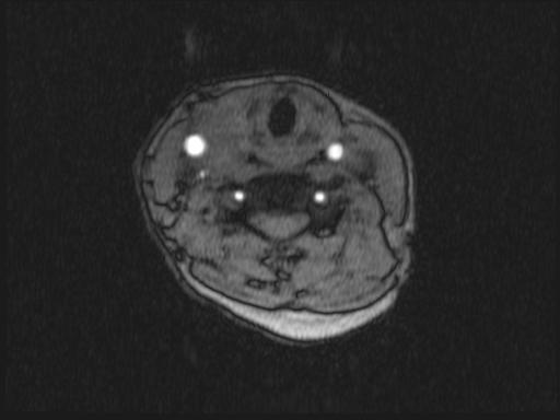 Bilateral carotid body tumors and right glomus jugulare tumor (Radiopaedia 20024-20060 Axial MRA 232).jpg