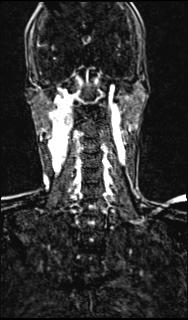 Bilateral carotid body tumors and right glomus jugulare tumor (Radiopaedia 20024-20060 MRA 109).jpg