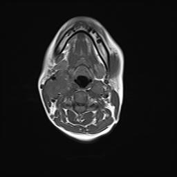 File:Bilateral carotid body tumors and right jugular paraganglioma (Radiopaedia 20024-20060 Axial 3).jpg