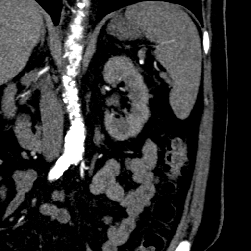 File:Bilateral delayed nephrogram from renal artery stenosis (Radiopaedia 47681-52362 B 11).png