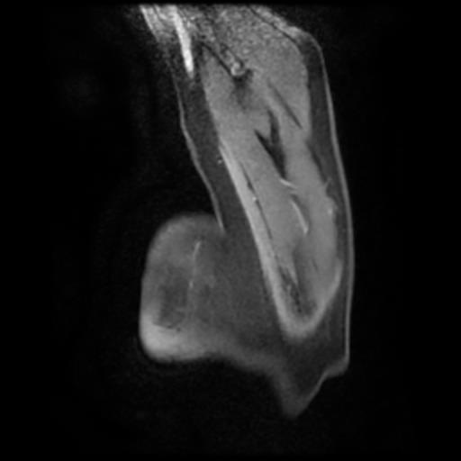 Bilateral elastofibromas dorsi (Radiopaedia 90158-107344 H 13).jpg