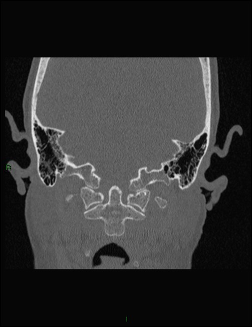 Bilateral frontal mucoceles (Radiopaedia 82352-96454 Coronal 341).jpg