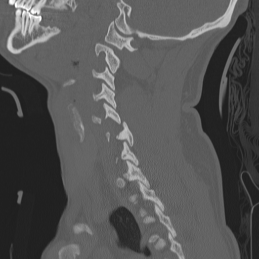 Bilateral locked facets (Radiopaedia 33850-35016 Sagittal bone window 34).png