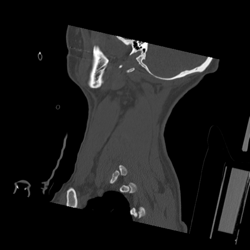 Bilateral locked facets (Radiopaedia 33850-35023 Sagittal bone window 6).png