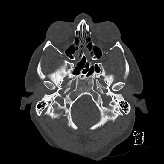 Bilateral occipital condyle fracture (type 2) (Radiopaedia 87675-104089 Axial bone window 18).jpg