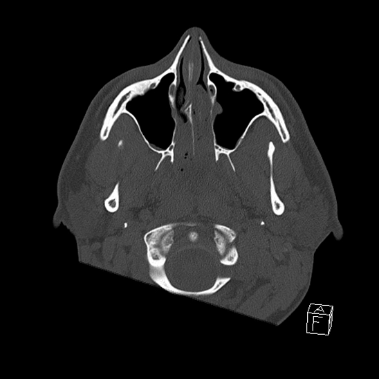 Bilateral occipital condyle fracture (type 2) (Radiopaedia 87675-104089 Axial bone window 3).jpg