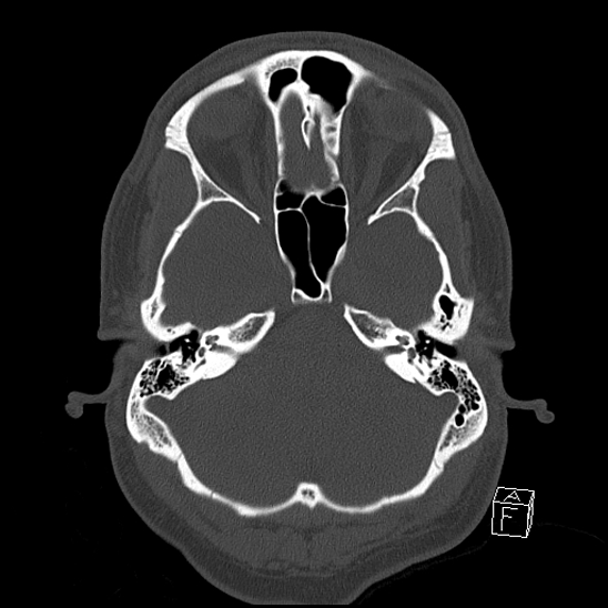 Bilateral occipital condyle fracture (type 2) (Radiopaedia 87675-104089 Axial bone window 31).jpg