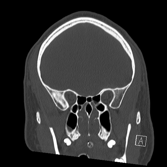 Bilateral occipital condyle fracture (type 2) (Radiopaedia 87675-104089 Coronal bone window 30).jpg