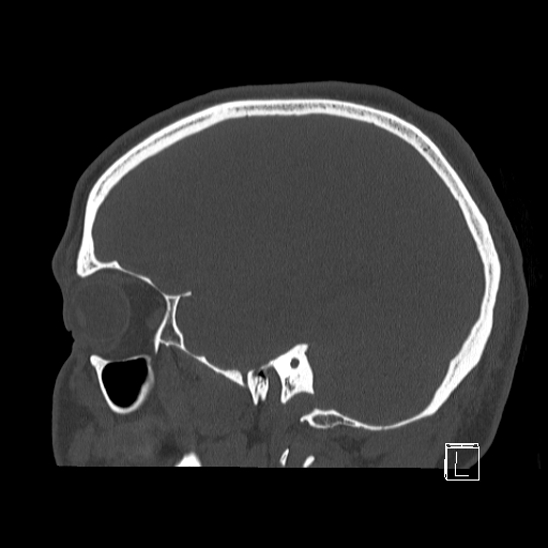Bilateral occipital condyle fracture (type 2) (Radiopaedia 87675-104089 Sagittal bone window 25).jpg