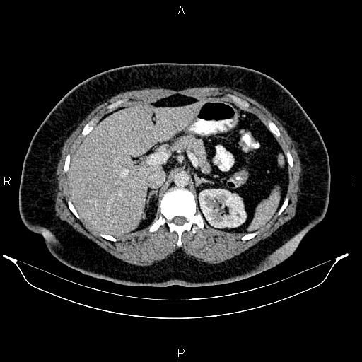 Bilateral ovarian dermoid cysts (Radiopaedia 85785-101603 A 34).jpg