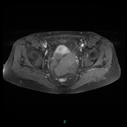 File:Bilateral ovarian fibroma (Radiopaedia 44568-48293 Axial T1 C+ fat sat 18).jpg