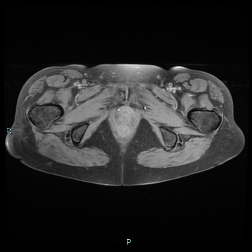 File:Bilateral ovarian fibroma (Radiopaedia 44568-48293 Axial T1 fat sat 27).jpg