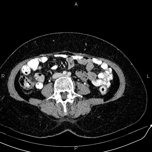 Bilateral ovarian serous cystadenocarcinoma (Radiopaedia 86062-101989 B 61).jpg