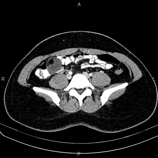 Bilateral ovarian teratoma (Radiopaedia 83131-97503 Axial With contrast 8).jpg