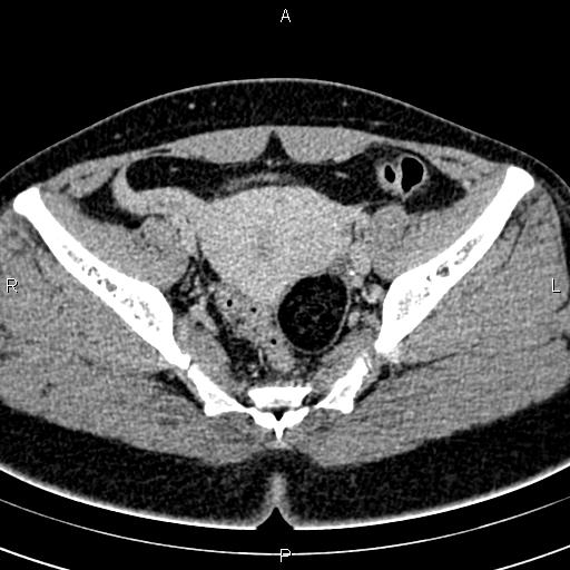 Bilateral ovarian teratoma (Radiopaedia 83131-97503 B 39).jpg