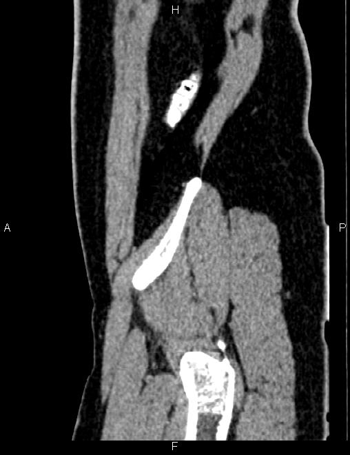 Bilateral ovarian teratoma (Radiopaedia 83131-97503 D 26).jpg