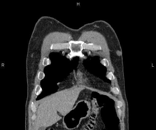 Bilateral pulmonary AVM (Radiopaedia 83134-97505 C 12).jpg