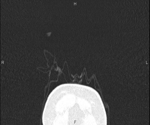 Bilateral pulmonary AVM (Radiopaedia 83134-97505 Coronal lung window 3).jpg