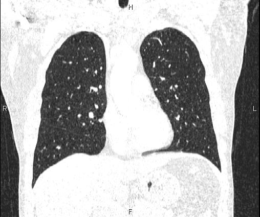 Bilateral pulmonary AVM (Radiopaedia 83134-97505 Coronal lung window 36).jpg