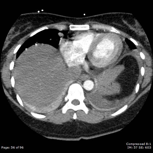 Bilateral pulmonary emboli with Hampton hump sign (Radiopaedia 54070-60246 Axial C+ CTPA 53).jpg