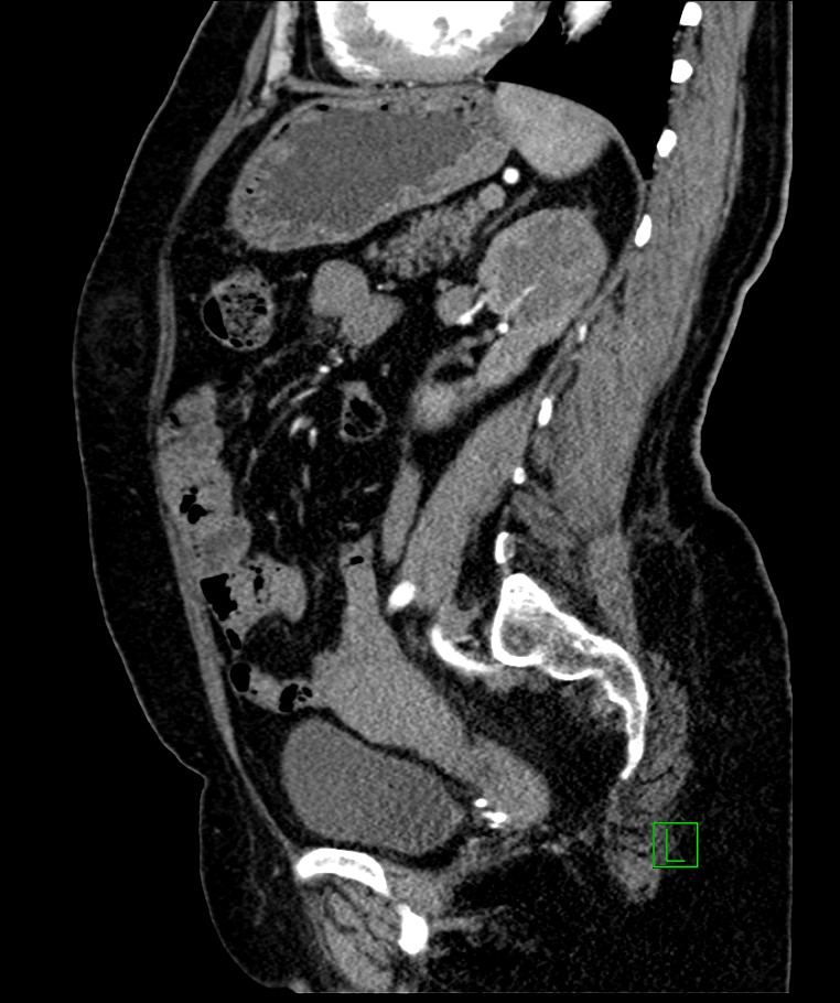 Bilateral sporadic synchronous clear cell renal cell carcinoma (Radiopaedia 85035-100575 E 51).jpg