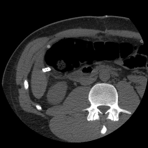 Bile leak from liver traumatic laceration (Radiopaedia 63463-72077 Axial Biliscopin 75).jpg