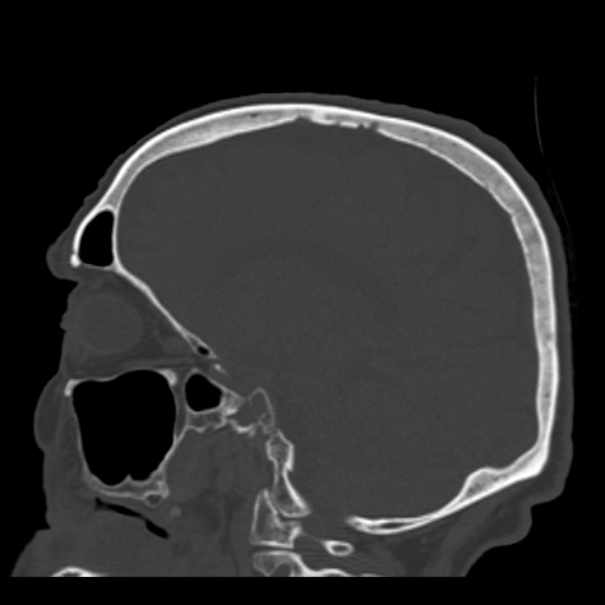 Biparietal osteodystrophy (Radiopaedia 46109-50463 Sagittal bone window 44).jpg