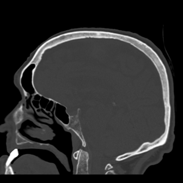 Biparietal osteodystrophy (Radiopaedia 46109-50463 Sagittal bone window 53).jpg