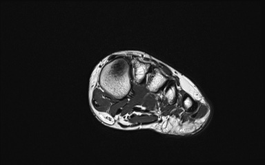 Bipartite hallux sesamoid diastasis (Radiopaedia 77133-89109 Coronal PD 9).jpg