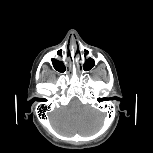 Bisphosphonate-related osteonecrosis of the jaw (Radiopaedia 71324-81642 non-contrast 155).jpg