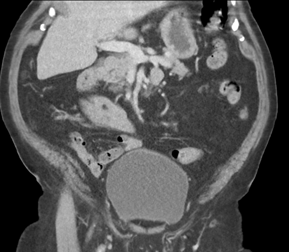 Bladder papillary urothelial carcinoma (Radiopaedia 48119-52951 C 31).png