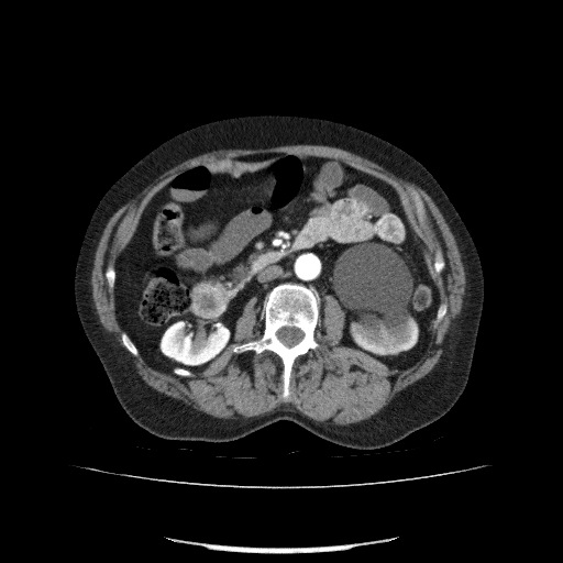 Bladder tumor detected on trauma CT (Radiopaedia 51809-57609 A 112).jpg