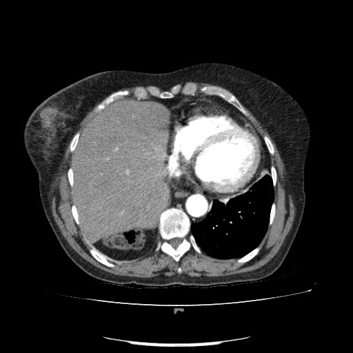 File:Bladder tumor detected on trauma CT (Radiopaedia 51809-57609 A 68).jpg