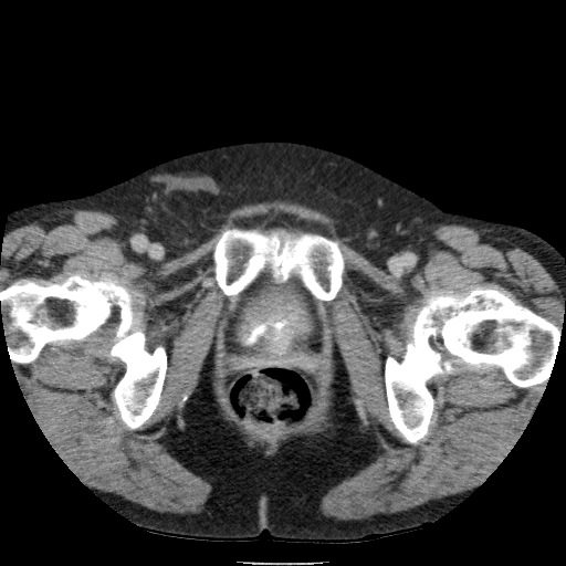 Bladder tumor detected on trauma CT (Radiopaedia 51809-57609 C 140).jpg