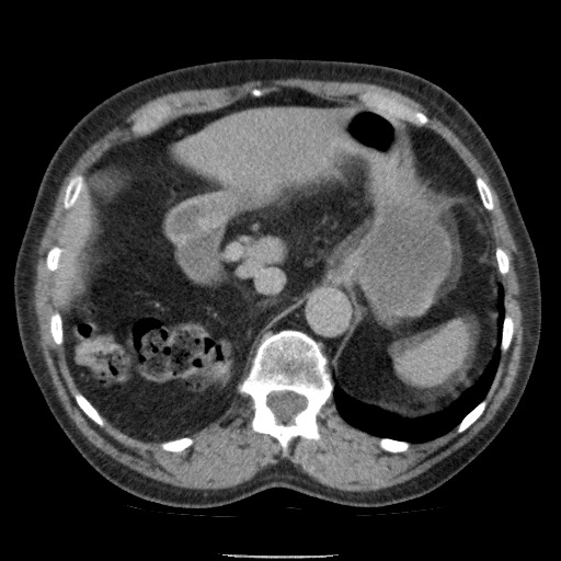 Bladder tumor detected on trauma CT (Radiopaedia 51809-57609 C 36).jpg