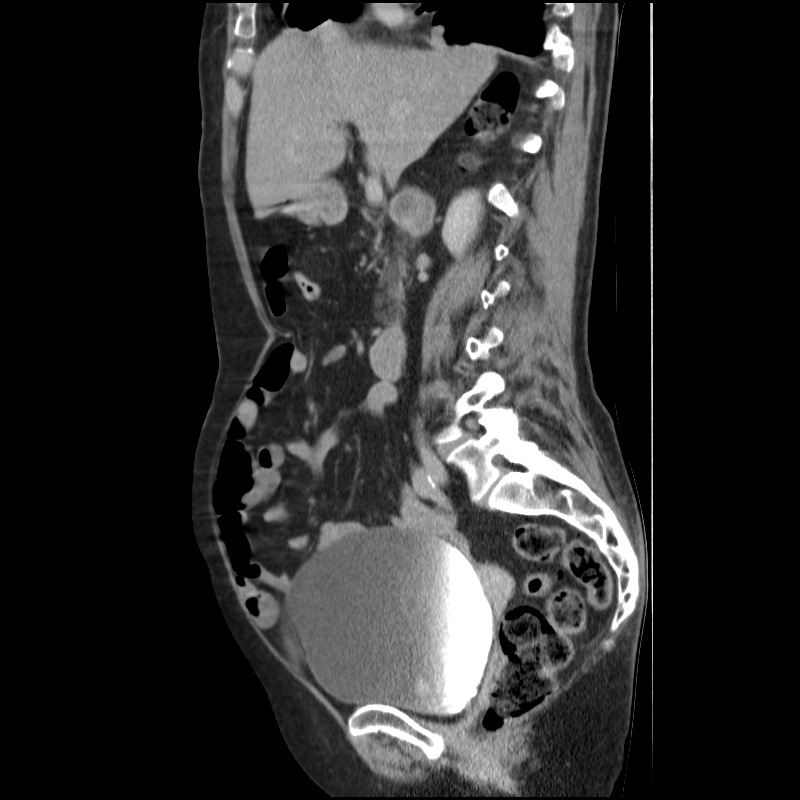 Bladder tumor detected on trauma CT (Radiopaedia 51809-57609 E 43).jpg