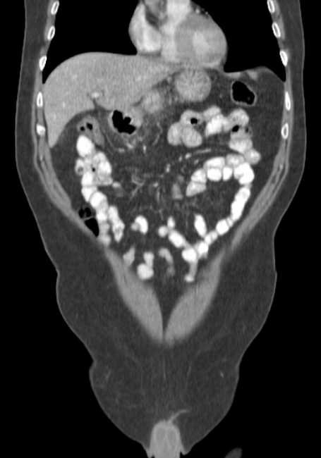 Bleeding duodenal ulcer and adenomyomatosis of gallbladder (Radiopaedia 61834-69861 B 63).jpg