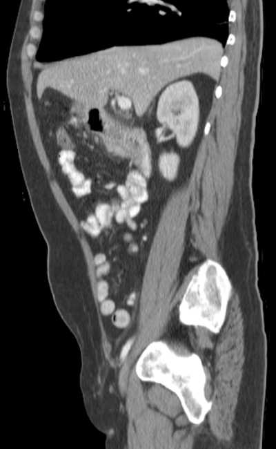 Bleeding duodenal ulcer and adenomyomatosis of gallbladder (Radiopaedia 61834-69861 C 35).jpg