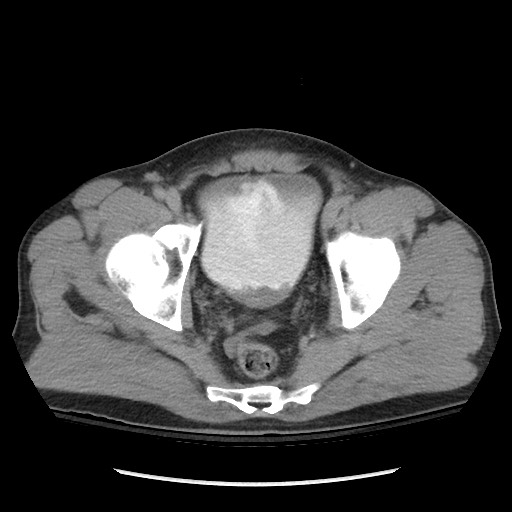 Blunt abdominal trauma with solid organ and musculoskelatal injury with active extravasation (Radiopaedia 68364-77895 Axial C+ delayed 125).jpg