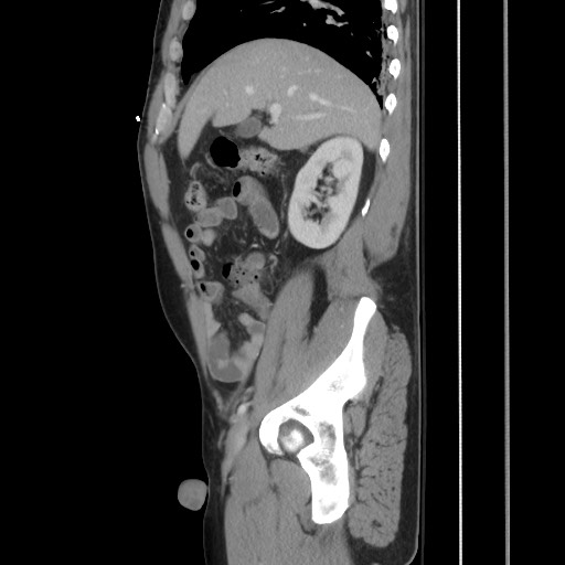 Blunt abdominal trauma with solid organ and musculoskelatal injury with active extravasation (Radiopaedia 68364-77895 C 51).jpg