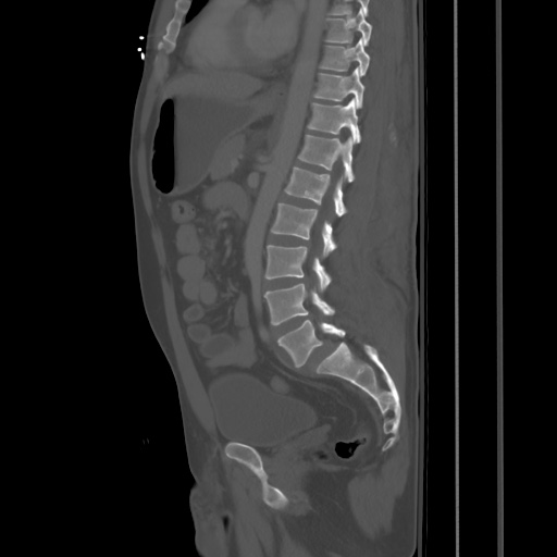 Blunt abdominal trauma with solid organ and musculoskelatal injury with active extravasation (Radiopaedia 68364-77895 Sagittal bone window 57).jpg