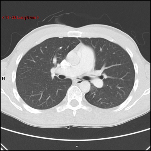 File:Blunt chest trauma - pulmonary interstitial emphysema and pneumomediastinum (Radiopaedia 20666-20552 Axial lung window 26).jpg