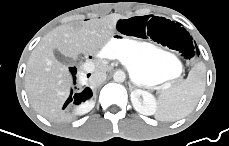 Blunt injury to the small bowel (Radiopaedia 74953-85987 A 31).jpg