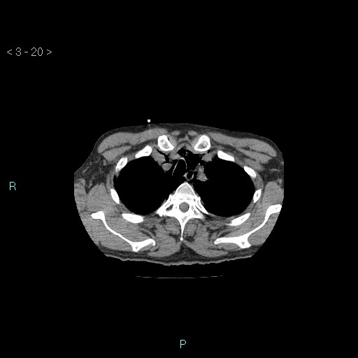 File:Boerhaave syndrome (Radiopaedia 27683-27897 Axial non-contrast 20).jpg