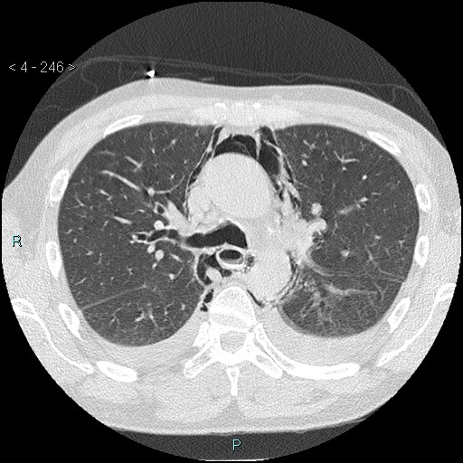 Boerhaave syndrome (Radiopaedia 27683-27897 lung window 7).jpg