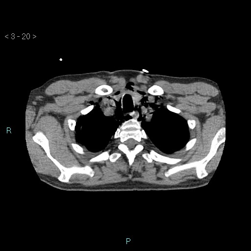 Boerhaave syndrome (Radiopaedia 27683-27897 oral contrast 20).jpg