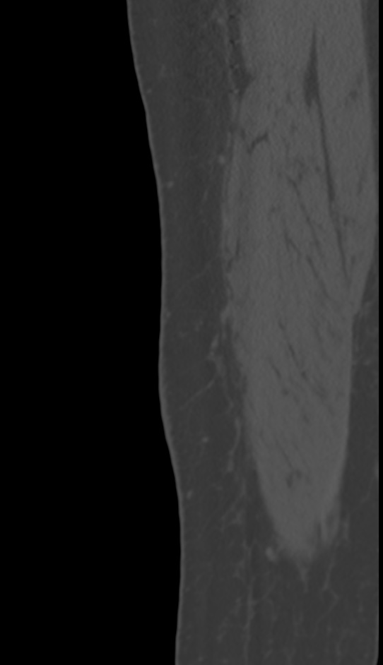 Bone metastasis - tibia (Radiopaedia 57665-64609 Sagittal bone window 11).jpg